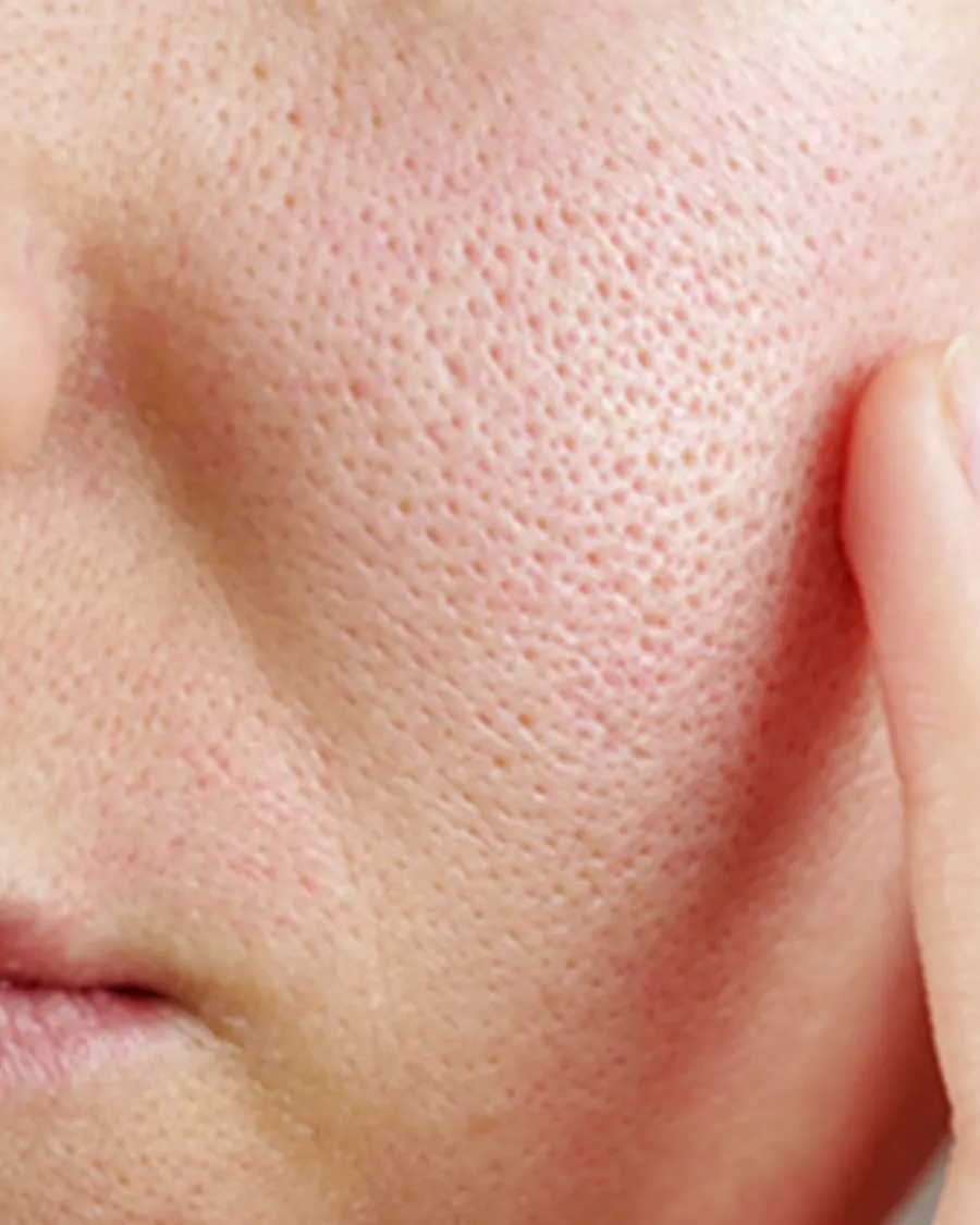 Advanced Treatment for Open Pores at Cinch Clinics